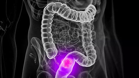 Study finds risk factors for early-onset colorectal cancer in males