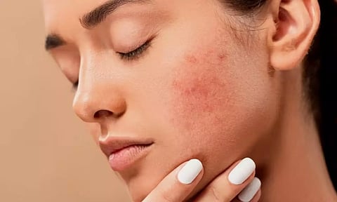 Representative image