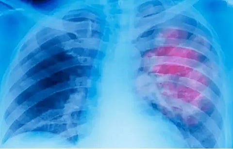 AI-model developed that could tell age from chest X-ray