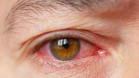 Dry Eye Disease (DED)