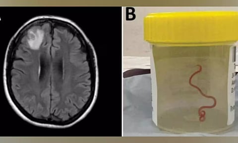 Eight Cm-Long Parasitic Roundworm (Image: IANS)