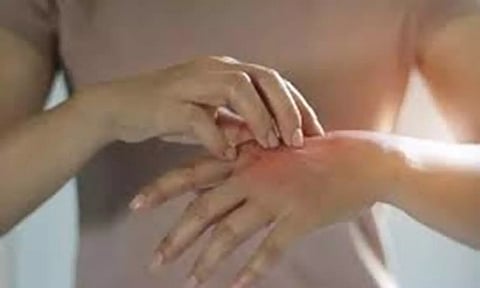 Representative image