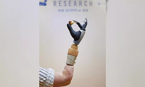 Bionic hand, merged with woman's nervous & skeletal systems, functional after years