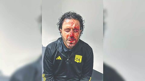 Blood stricken face of Lyon’s coach Fabio Grosso