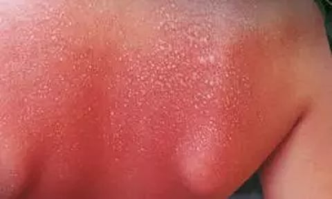 Representative image