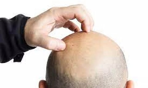 Representative image