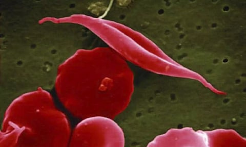 A blood cell altered by sickle cell disease (Photo: AP)
