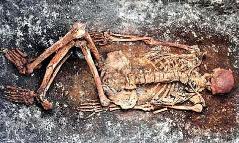 Past skeletons give clues to modern medical mysteries