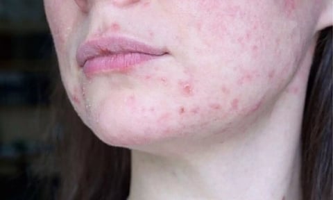 AI may automate diagnosis of lupus nephritis: Report