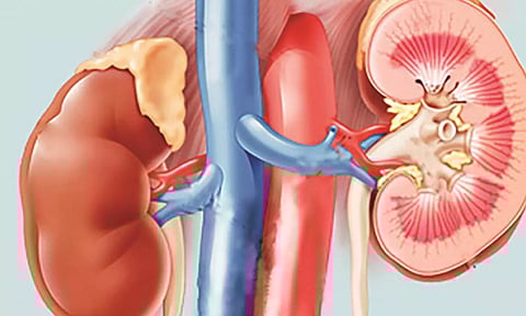 Nephrologists have underlined the need to take various measures to safeguard the community from the ill effects of the irrational use of antibiotics. (IANS) 