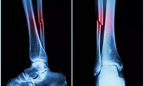 Bone Fracture Illustration (IANS)