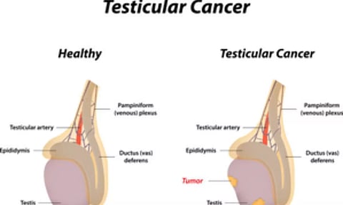 Testicular Cancer details (IANS)