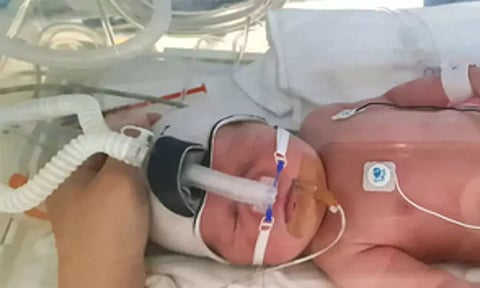 continuous positive airway pressure (CPAP) (IANS)