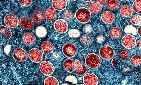 The image provided by the National Institute of Allergy and Infectious Diseases (NIAID) shows a colorized transmission electron micrograph of monkeypox particles (red) found within an infected cell (blue) (AP)