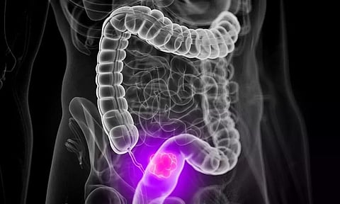 Rise in colorectal cancer among teens a serious issue