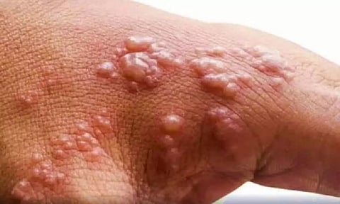 Representative Image