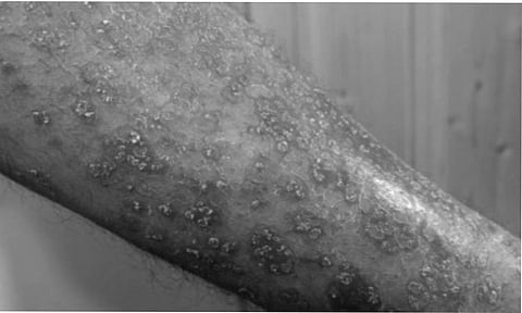 Skin cancer surges worldwide in older men in last 30 years: Study