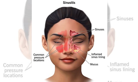 Surgery more effective in treating chronic sinus (IANS)