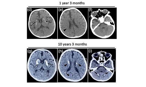 Indian researchers find rare gene mutation linked to recurrent neurological decline in kids