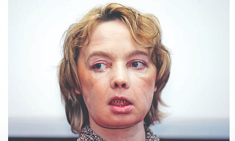 Unsettled futures: Unresolved questions of face transplants, 20 years on