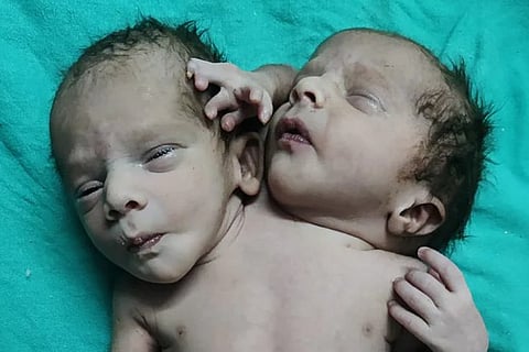 New baby with two heads, three hands