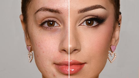 Representative image