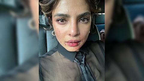 Priyanka Chopra with a bruised face