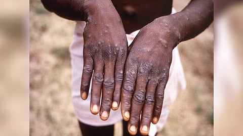 Representative image