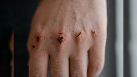 Representative image