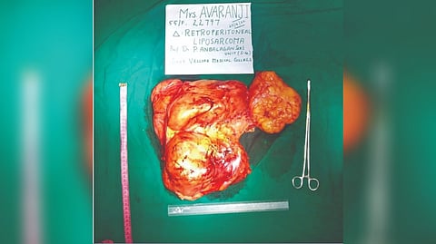 Cancerous tumour removed from the stomach of a woman.