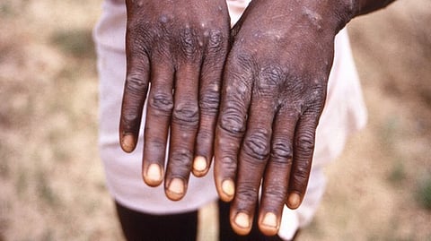 No Monkeypox case reported in Mumbai so far: BMC