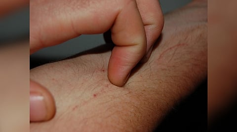 Representative image