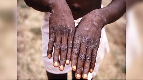 Representative image