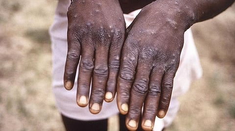 Representative image