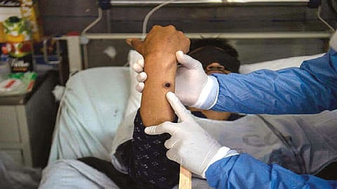 Not the monkeypox docs thought they knew