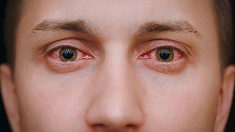 Representative Image