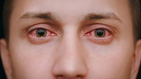 Representative Image