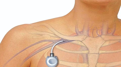 Chemoport device to enable less painful cancer treatment at GRH