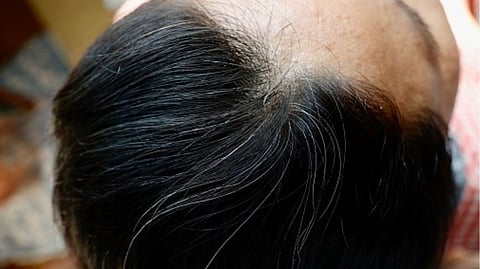 Representative image