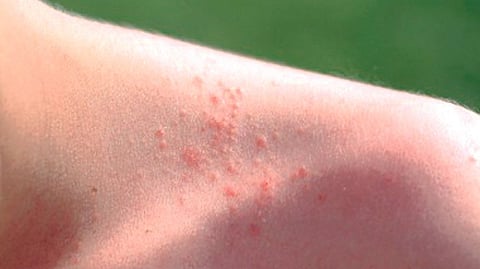 Representative image