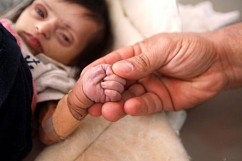 A nurse holds a hand of malnourished two-month-old child before her death