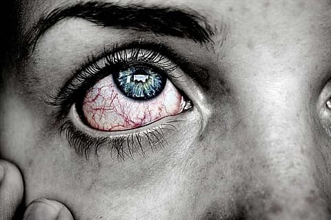 US woman first to be infected with 14 eye worms