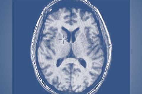 Scientists link 'brain fog' with inflammation in body