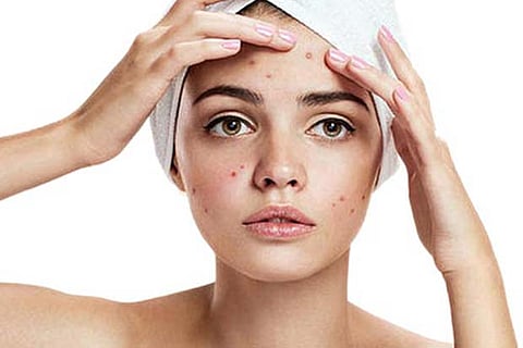 Probiotics an effective alternative to treat acne