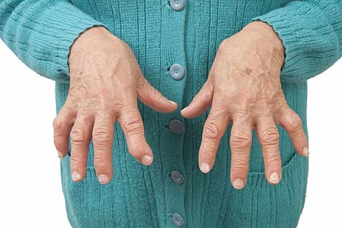 What is Rheumatoid Arthritis