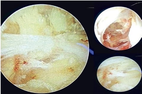 Screengrab of the fistulous tract