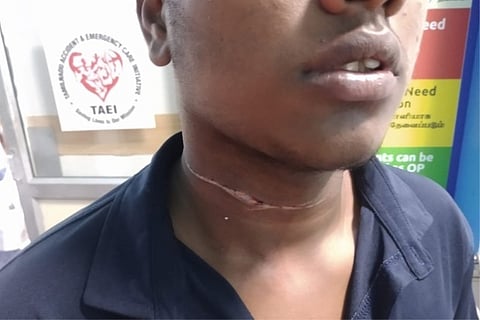 Caption: Mohanraj suffered injuries after a manja thread slit his throat