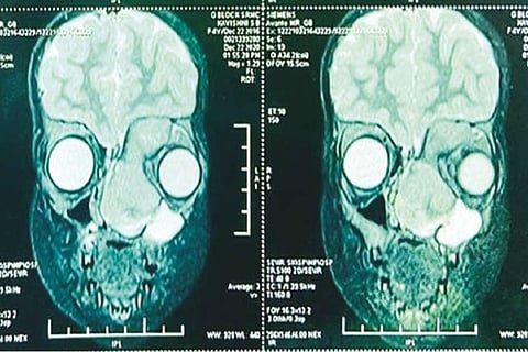 The scan shows the tumour in a 4-year-old girl?s nasal passage progressing towards her left eye