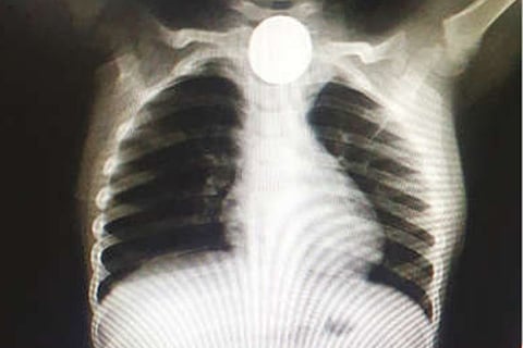 The x-ray showing the coin stuck in the 2-year-old?s throat