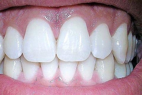 Chennai researchers say gum tissue key to cure spinal cord injuries